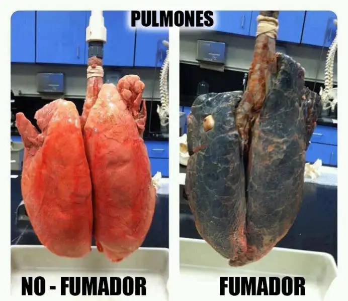 Así quedan los pulmones de un hombre que fumó durante 30 años