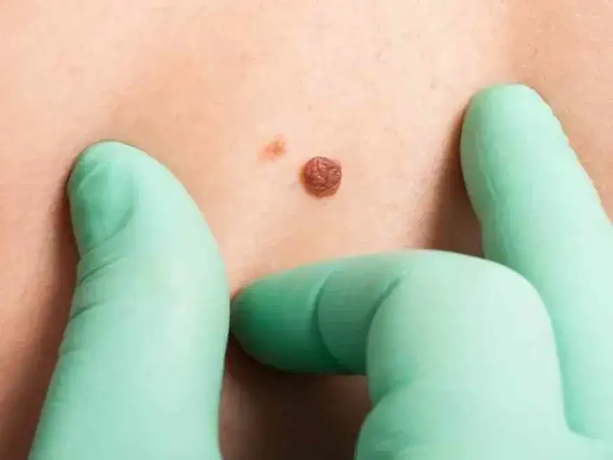 El melanoma es el cáncer de piel más agresivo. La vacuna diseñada por investigadores de CONICET permite tratar estadíos tempranos de la enfermedad. Foto: Archivo.