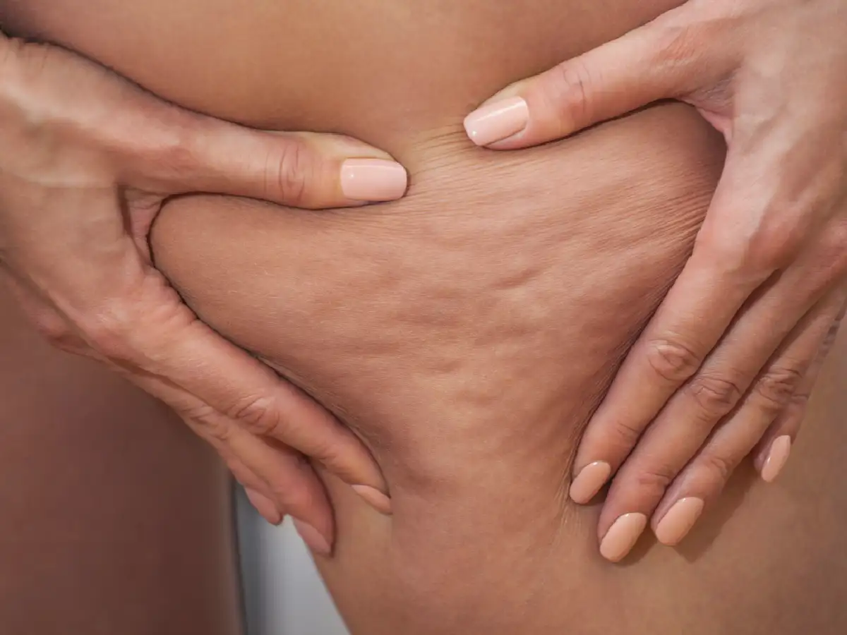 Estudio revela que se puede reducir                 la celulitis en un 90% de los pacientes 