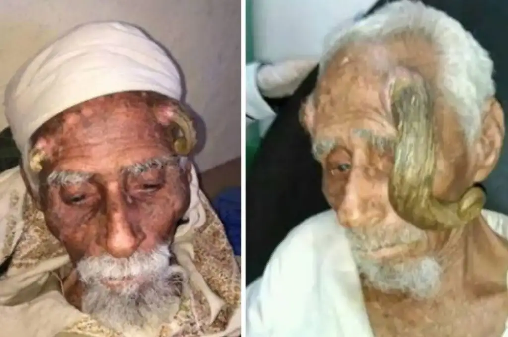 Murió Alí Anter, el hombre más viejo del mundo, tras una operación para quitarle los cuernos en la cabeza