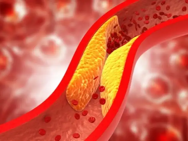 Una molécula intestinal reconfigura el origen de la aterosclerosis y abre nuevas vías terapéuticas