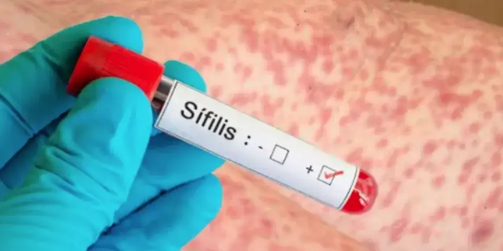 La sífilis es un enfermedad de transmisión sexual.