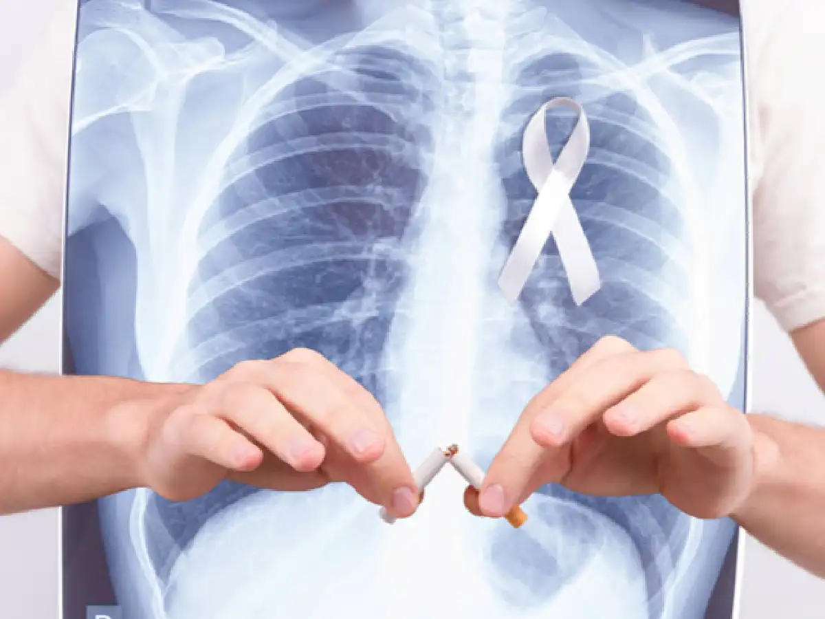 Cáncer de pulmón: más de 10 mil personas murieron el año pasado en Argentina