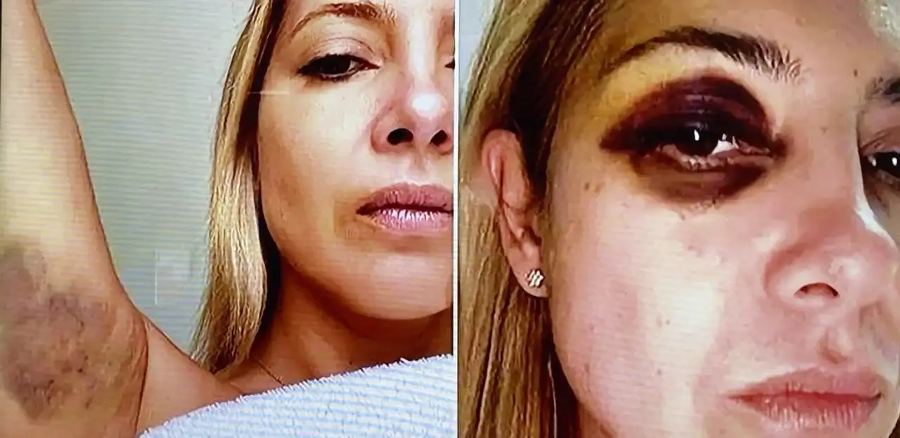 Fabiola Yañez con marcas de los golpes. (Foto: archivo)
