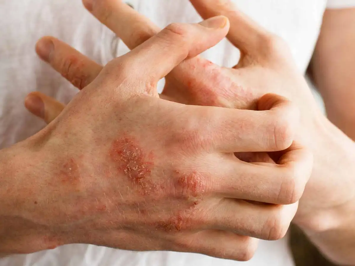 Una droga para la psoriasis muestra "tasas de remisión del 100% a 5 años", según un estudio