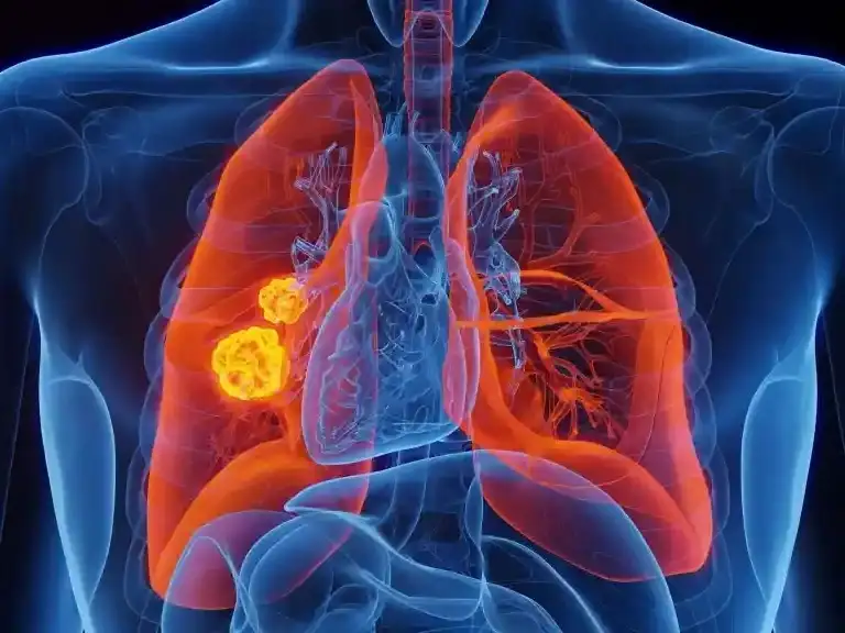 El cáncer de pulmón es uno de los más comunes.