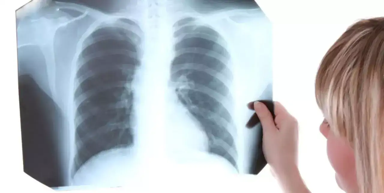 Más de 700 personas fueron diagnosticadas con tuberculosis en 2022 en Santa Fe