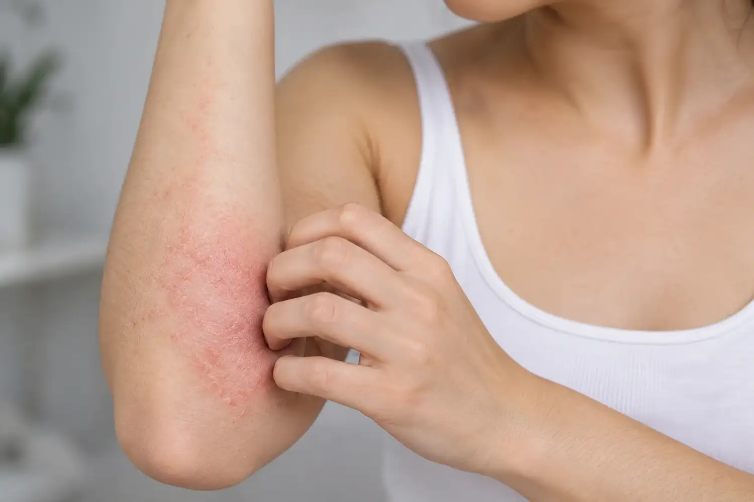 Dermatitis atópica: casi la mitad de los pacientes postergó consultas por motivos económicos