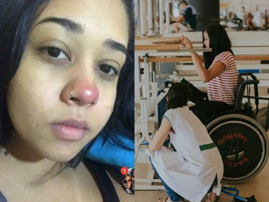 Brasil: un piercing en la nariz la dejó parapléjica