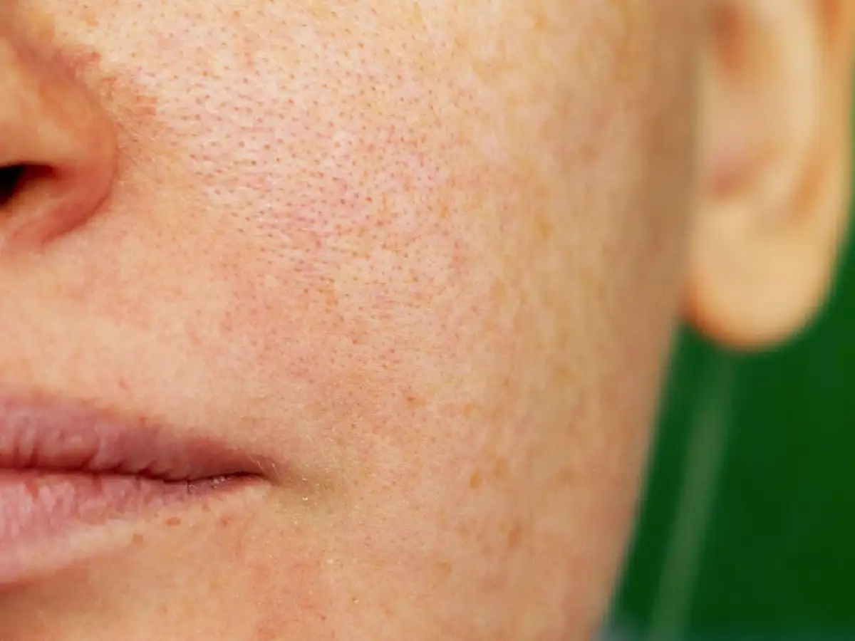 Ni bigotes ni manchas:  es melasma 