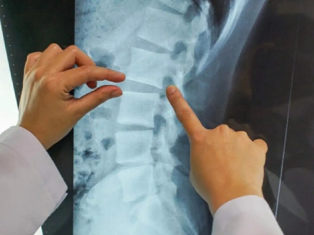 Realizaron en Italia el primer trasplante de vértebras humanas