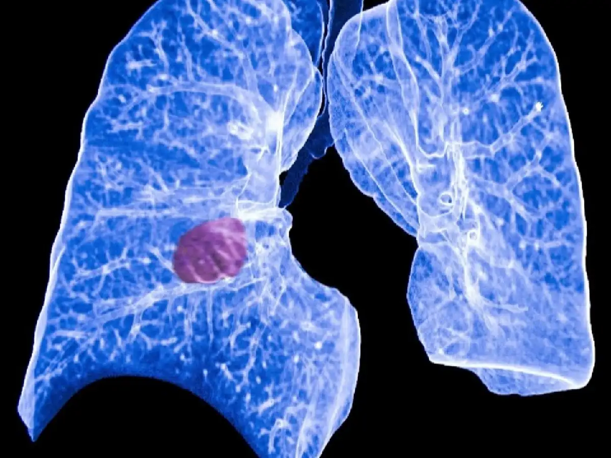 Prueban un fármaco oncológico que podría evitar la metástasis y reducir el tumor