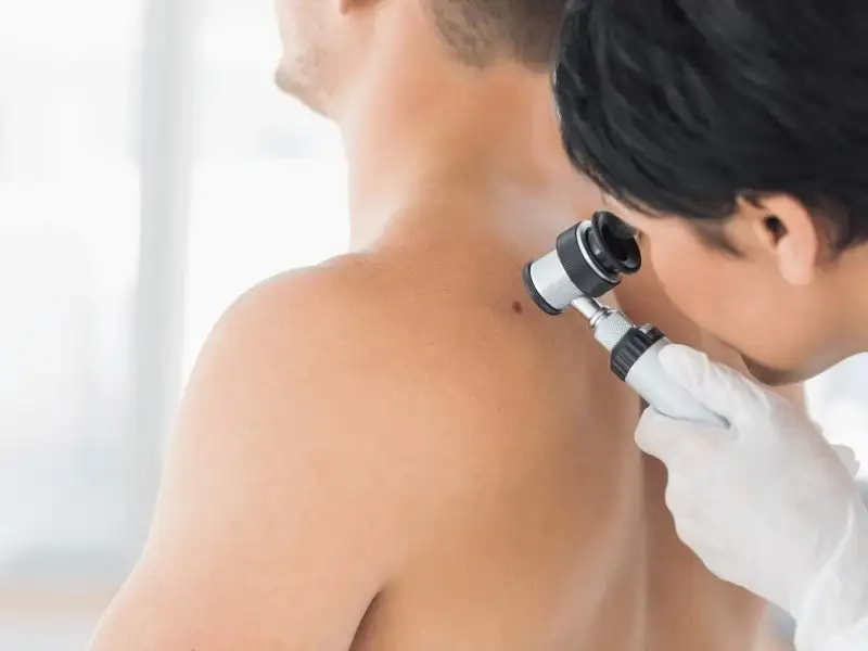 Día Mundial del Cáncer de Piel: la importancia de la prevención y el diagnóstico precoz
