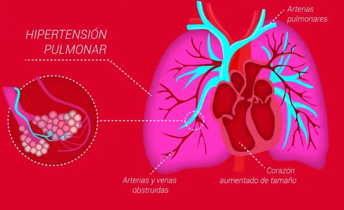 Día Mundial de la Hipertensión Pulmonar en Rosario
