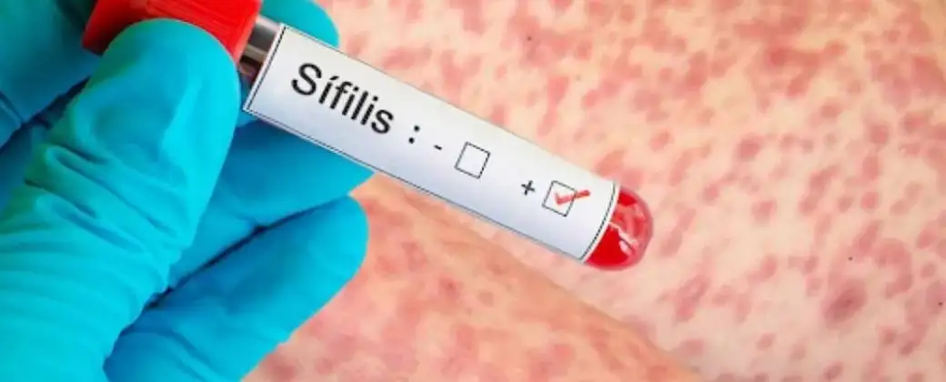 La sífilis es una infección de transmisión sexual causada por una bacteria.