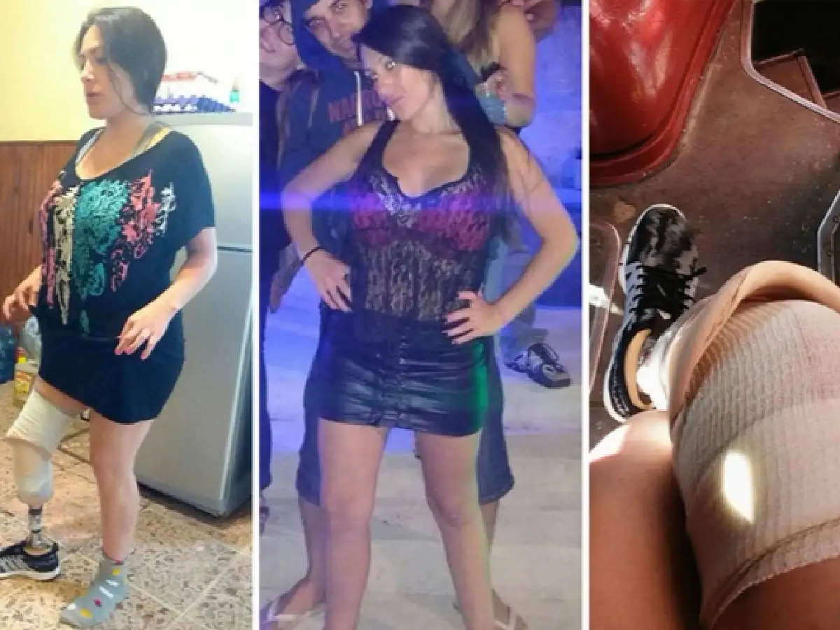 Se hizo una "lipo" pero perdió parte de una pierna