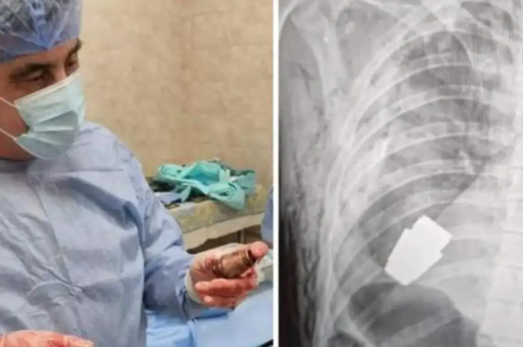 Le extrajeron del pecho una granada sin detonar a un soldado ucraniano