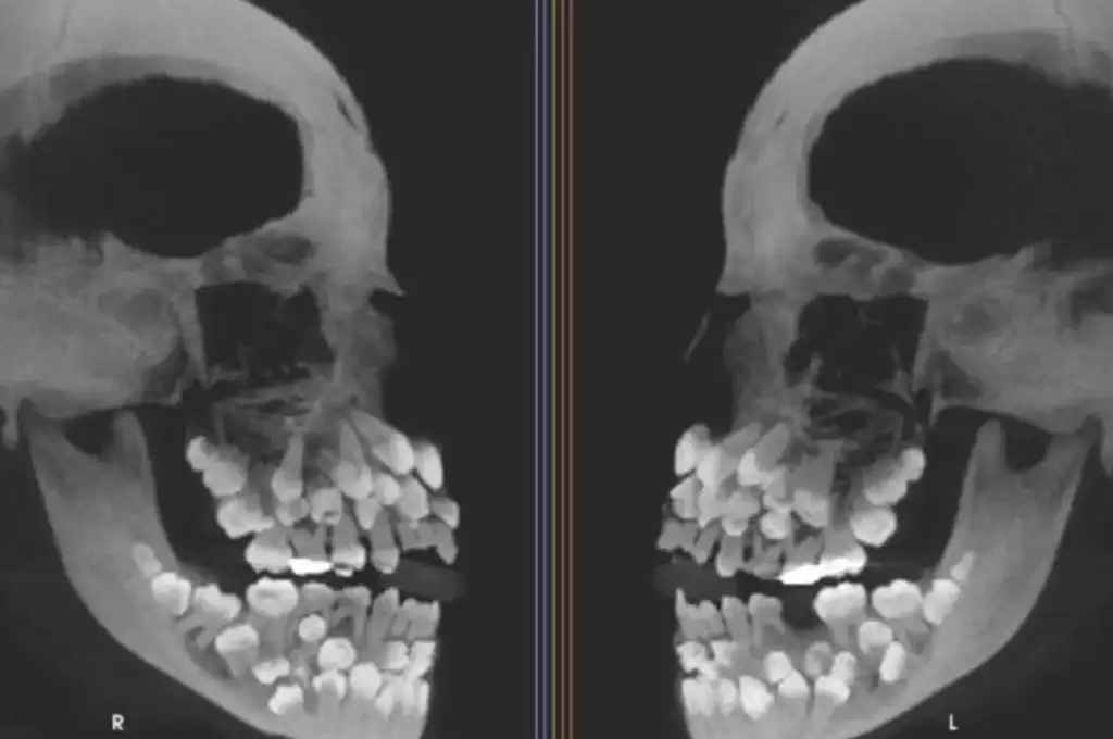 Brasil: una niña con 81 dientes  se convirtió en un desafío clínico para los odontólogos