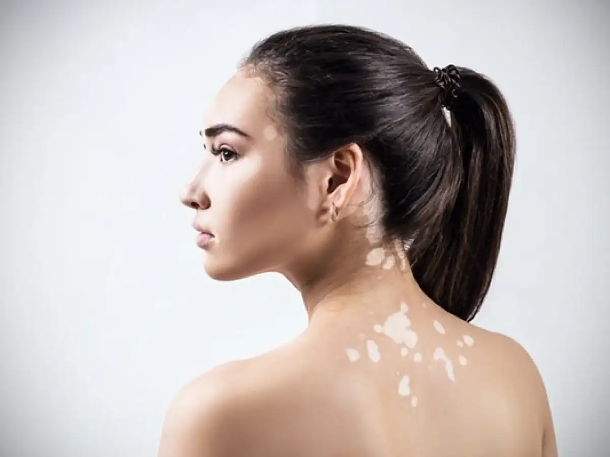 El vitiligo es una enfermedad que afecta al 1% de la población mundial.
