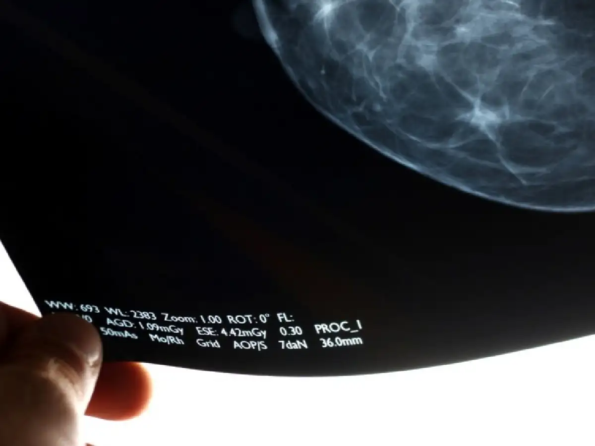 Cuáles son los tres tipos de cáncer más letales en la Argentina